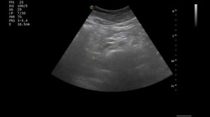 УЗИ лимфатических узлов