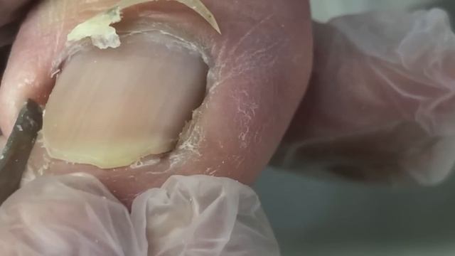 Swollen Toes With Ingrown Toenails, Professional Pedicure【Crazy Pedicure Room】