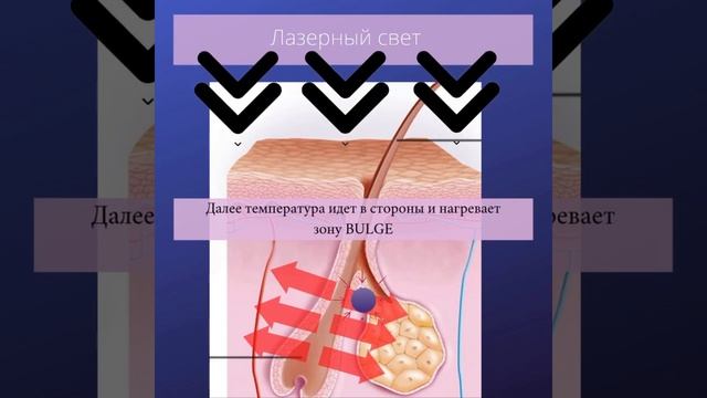 Как работает лазерная эпиляция? смотреть онлайн