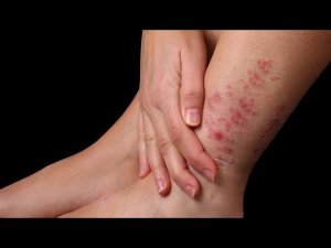 Как быстро вылечить кожное заболевание