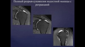 Базовый курс по МРТ  b  Лекция «МР семиотика повреждений плечевого сустава»  Лектор  Учеваткин А А
