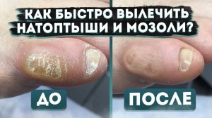 Как избавиться от мозолей на ногах? Рекомендации подолога|Как появляются мозоли|MedPed