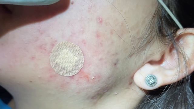 Lip Extractions. Whiteheads, Blackheads, Acne Extractions On Face. Inflammatory Pustules.