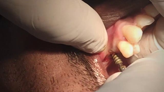 Implants in the upper posterior region without any sinus lift procedure. смотреть онлайн