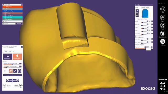Exocad Quick Guide  New Attachment Feature