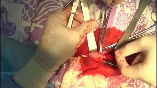 Правостороння герниопластика по Лихтенштейну смотреть онлайн