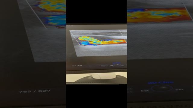 Исследование сосудов шеи. Огромная бляшка в сонной артерии. Узи сосудов. Флеболог Москва смотреть онлайн