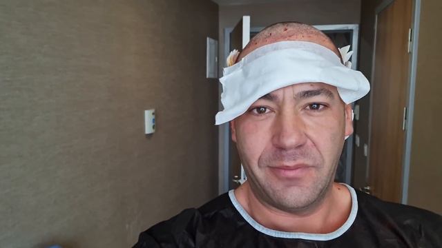 Влог моя Трансплантация Волос смотреть онлайн