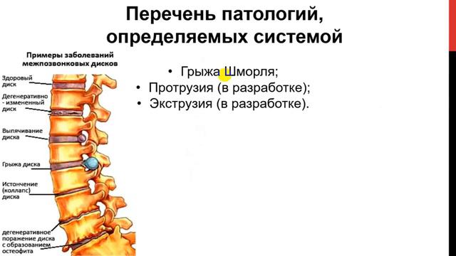 Искусственный интеллек - Селютин Александр - Lumbar Spine смотреть онлайн