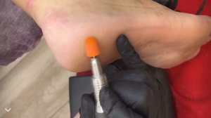 Обработка стоп колпачками