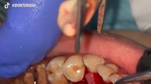 Удаление зубного камня