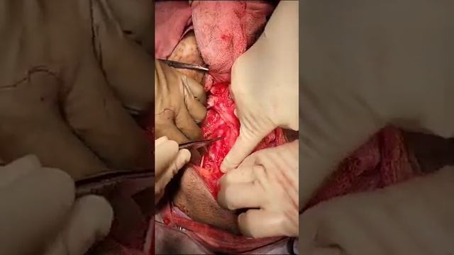 Retroperitoneal Pelvic lymph node dissection смотреть онлайн