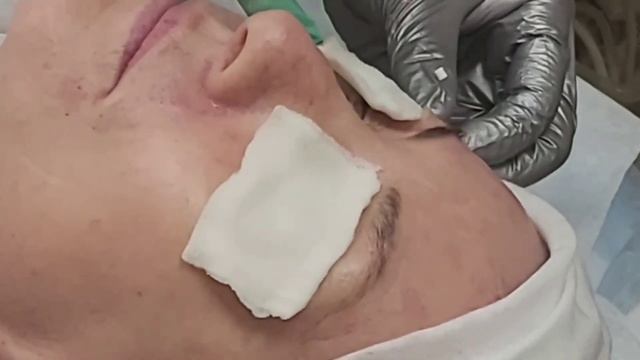 АирисКом студенты учатся: семинар, мезонити Cog для лифтинга бровей и лба.