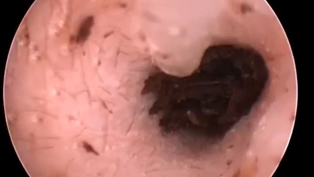 Winston's left ear video otoscope ear canal flush смотреть онлайн