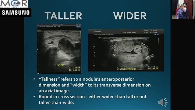 ACR TIRADS SCORING FOR THYROID NODULES 1 смотреть онлайн