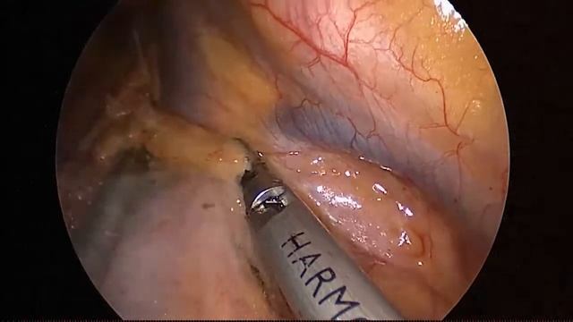 Asvide: Uniportal VATS mediastinal lymph node dissection (right side) смотреть онлайн