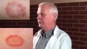 Розовый лишай Жибера: возбудитель, инкубационный период, пути передачи, осложнения