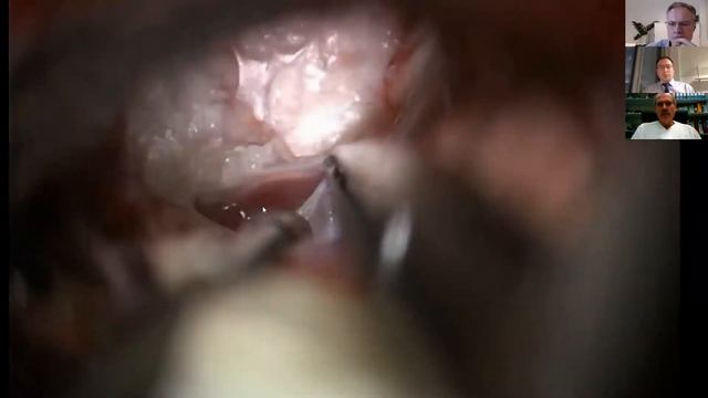 Cerebellopontine angle endoscopy feasibility & technical considerations смотреть онлайн