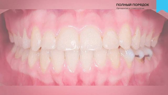 Наши любимые самолигирующие металлические брекеты Damon Q лечат скученность без удаления смотреть онлайн