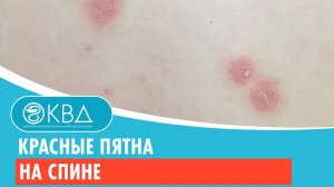 ? Красные пятна на спине. Клинический случай №307
