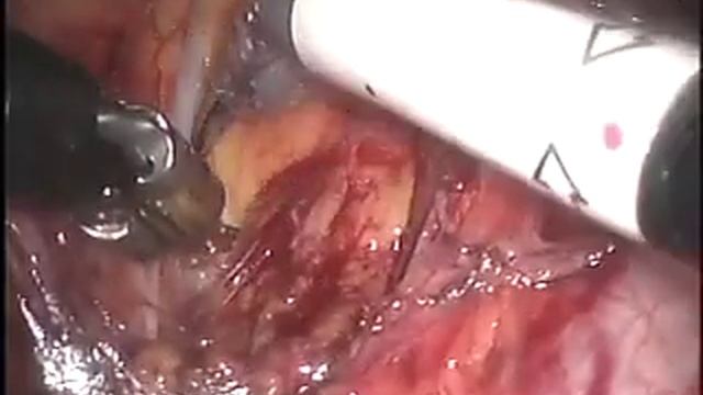 da Vinci (Standard) / Robotic Aortic Lymph Node Dissection смотреть онлайн