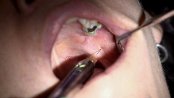 Dentistry Anaesthesia LTI 5 Mandibular Anaesthesia Techniques Live Patient