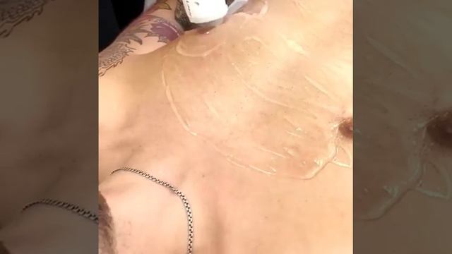 Лазерное удаление волос на теле мужчин смотреть онлайн