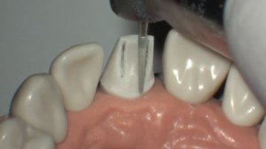 Iwata Jun - методика препарирования переднего зуба под коронку