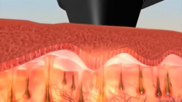 Противопоказания к Лазерной Эпиляции смотреть онлайн