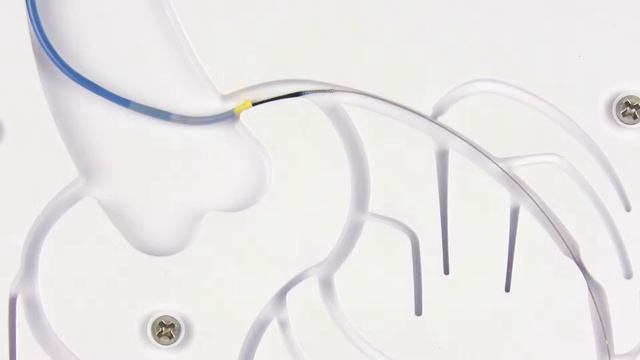 Venture® 0.014" Catheters, Deployment смотреть онлайн