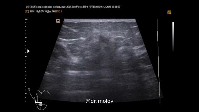 Конкурс "Опиши и заключись за @dr.molov” Кейс №23 УЗИ молочных желез смотреть онлайн