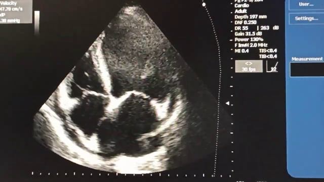 3 месяца спустя ТЕЛА с тромбами в ходу Сейчас проблема с левыми отделами сердца смотреть онлайн