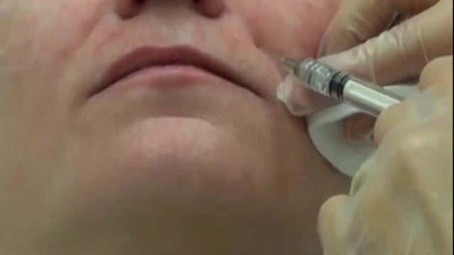 Как убрать морщины? Пластика лица. Софтлифтинг. смотреть онлайн