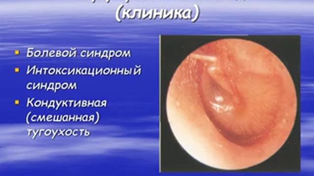 Заболевания наружного и среднего уха смотреть онлайн