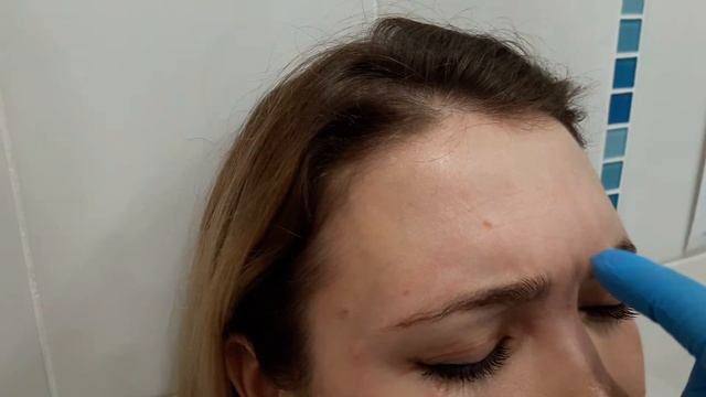 Аириском:  Первая практика студента по введению БОТОКСА. Верхняя и средняя части лица