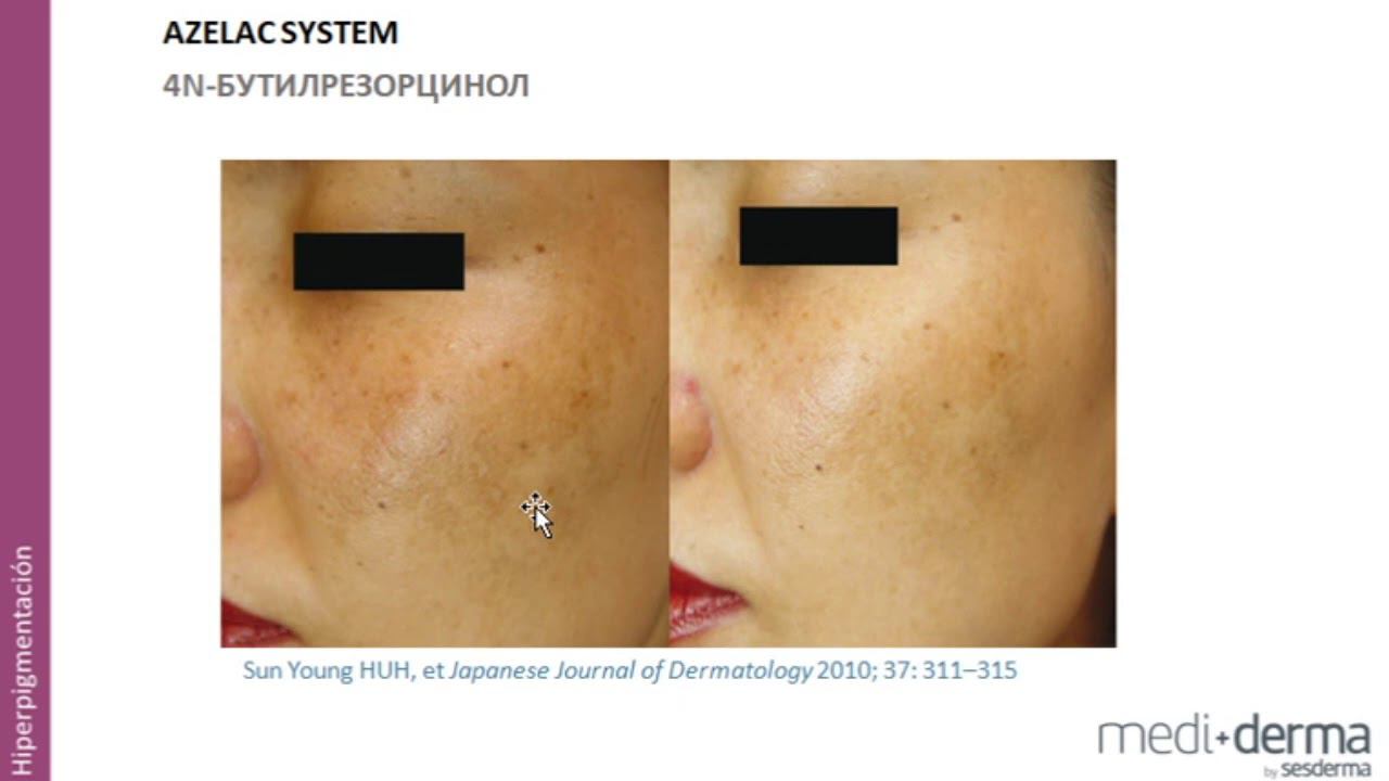 Отбеливание с Sesderma смотреть онлайн