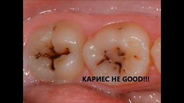 Кариес не гуд! (Caries not good!) смотреть онлайн
