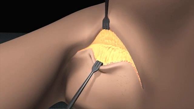 Axillary Incision: 3D Animation of Axillary Lymph Node Dissection Procedure Part - 2 смотреть онлайн