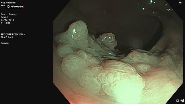 LST-GH прямая кишка