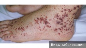 Тромбоцитопеническая пурпура. Как лечить тромбоцитопеническую пурпуру.