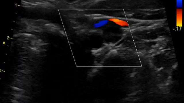 Окклюзия ВСА смотреть онлайн