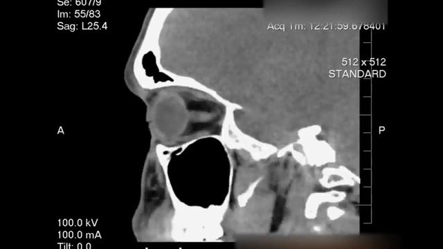 КТ околоносовых пазух с искривленной носовой перегородкой смотреть онлайн