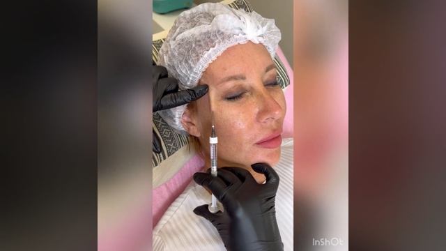 Подтяжка лица филлерами. Контурная пластика. Лифтинг. Заполнение височной зоны. Коррекция лица.