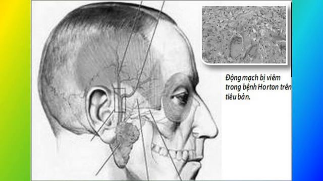 Nhận Biết Bệnh Tắc Tĩnh Mạch Võng Mạc