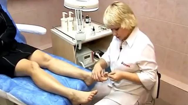 Вросший ноготь - аппаратный педикюр смотреть онлайн