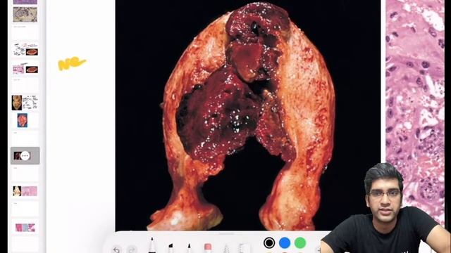 Interesting Cases in Pathology | Dr Ranjith A R смотреть онлайн
