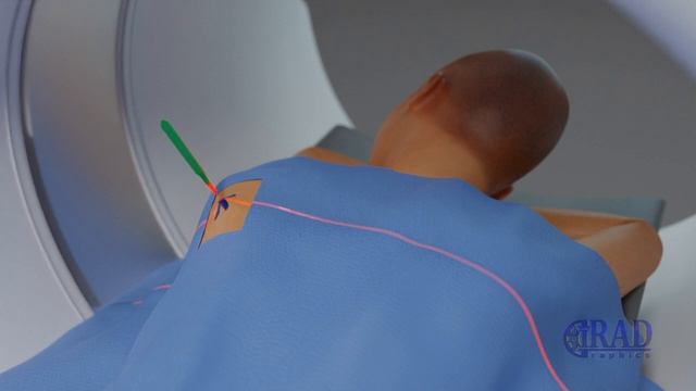 Lung Tumor Biopsy смотреть онлайн