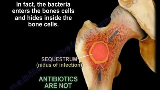 Bone Infection, Osteomyelitis, Briefly - Everything You Need To Know - Dr. Nabil Ebraheim смотреть онлайн