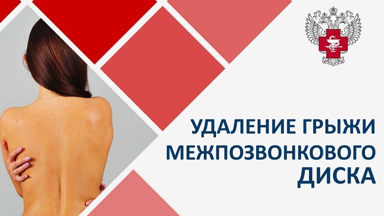 Удаление грыжи межпозвонкового диска. Как проходит удаление грыжи межпозвонкового диска лазером? смотреть онлайн