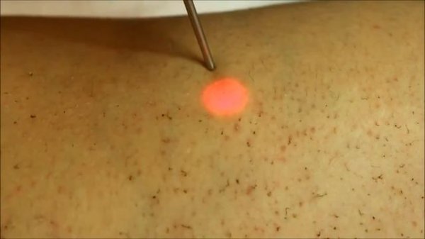 Лазерная эпиляция на александритовом лазере Incanto